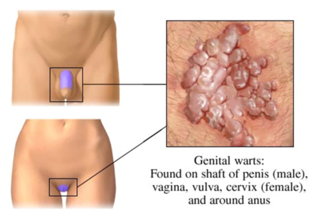 Genital hpv meaning